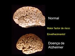 Alzheimer